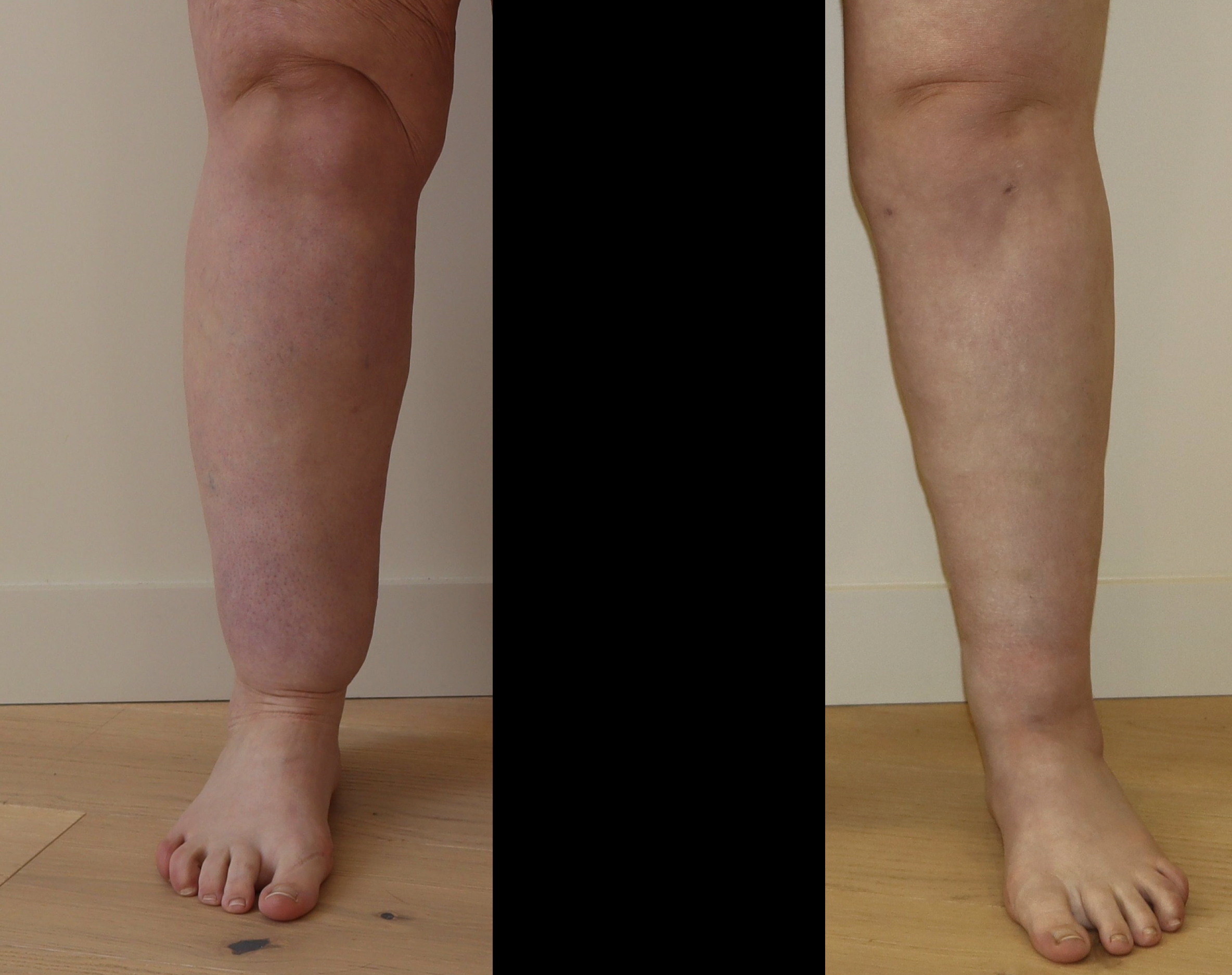 Avant/Après lipoaspiration lipoedeme